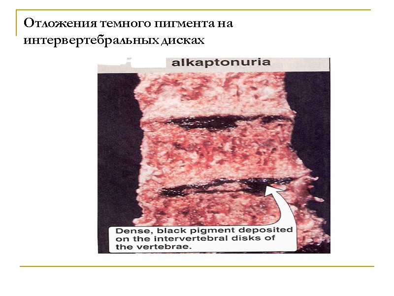 Отложения темного пигмента на интервертебральных дисках